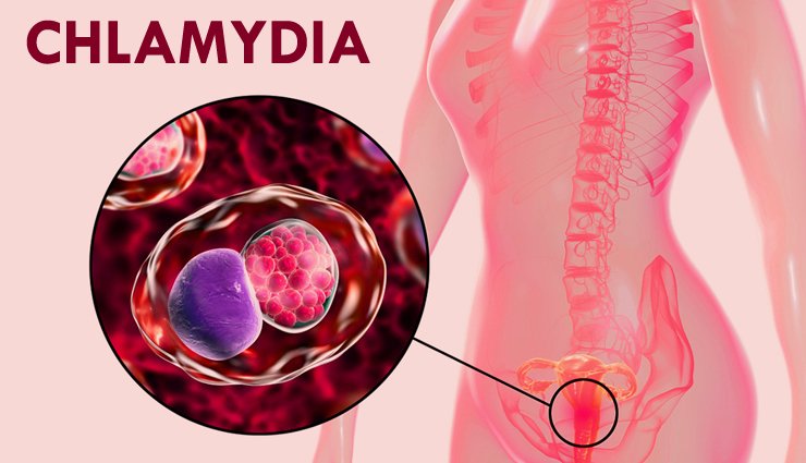 15 Home Remedies That are Effective To Control Chlamydia ...