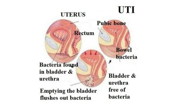 25 Home Remedies For Uti (Urinary Tract Infection) In Men ...