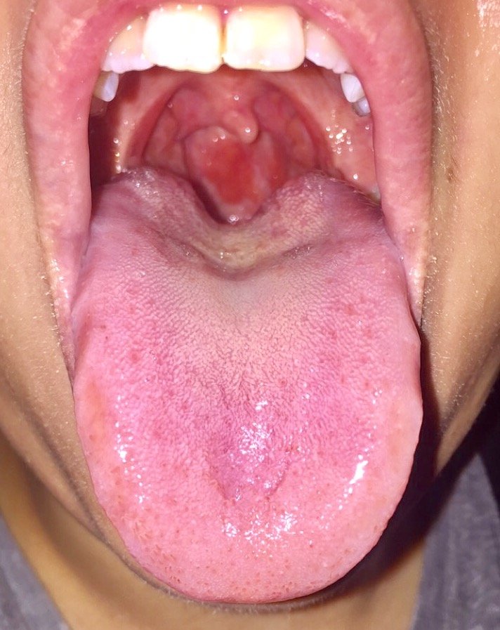 Bumps in my throat, could it be laryngitis, an std or throat cancer ...