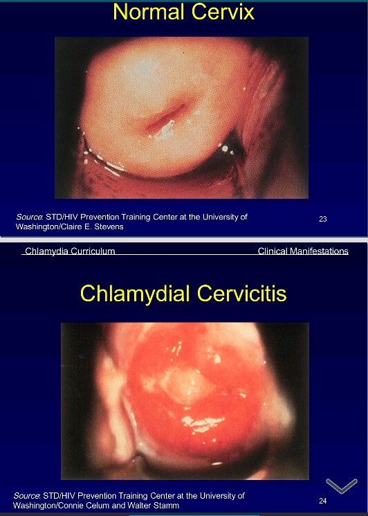 Chlamydia Cervicitis