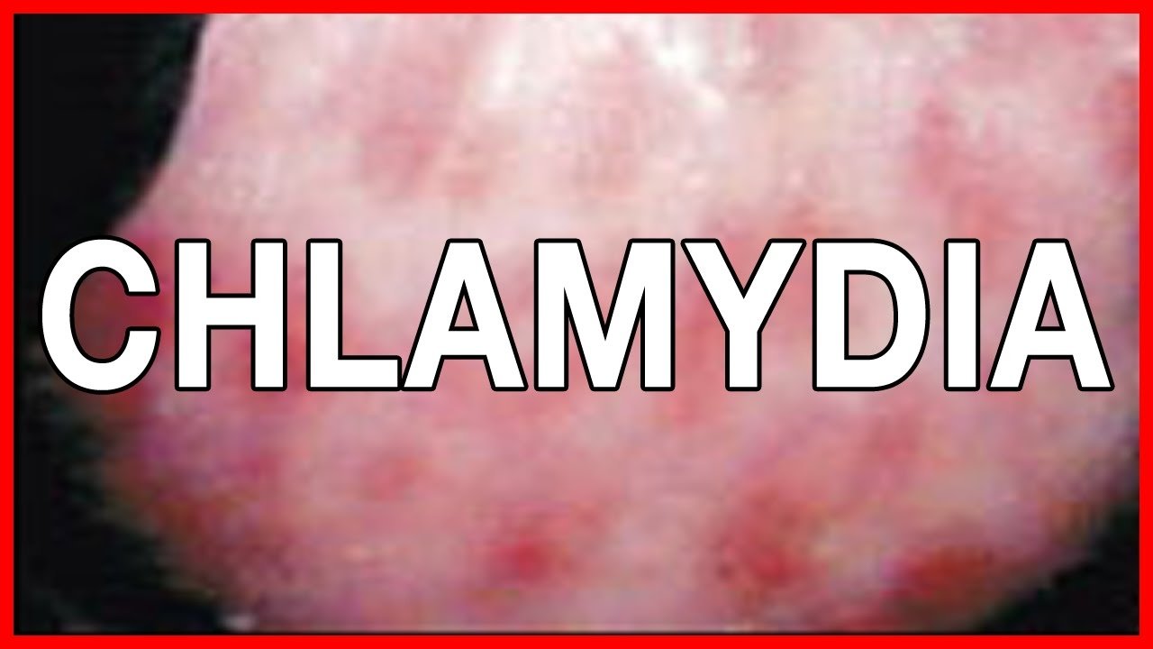 Chlamydia in Women and Men Symptoms, Signs and Remedies ...