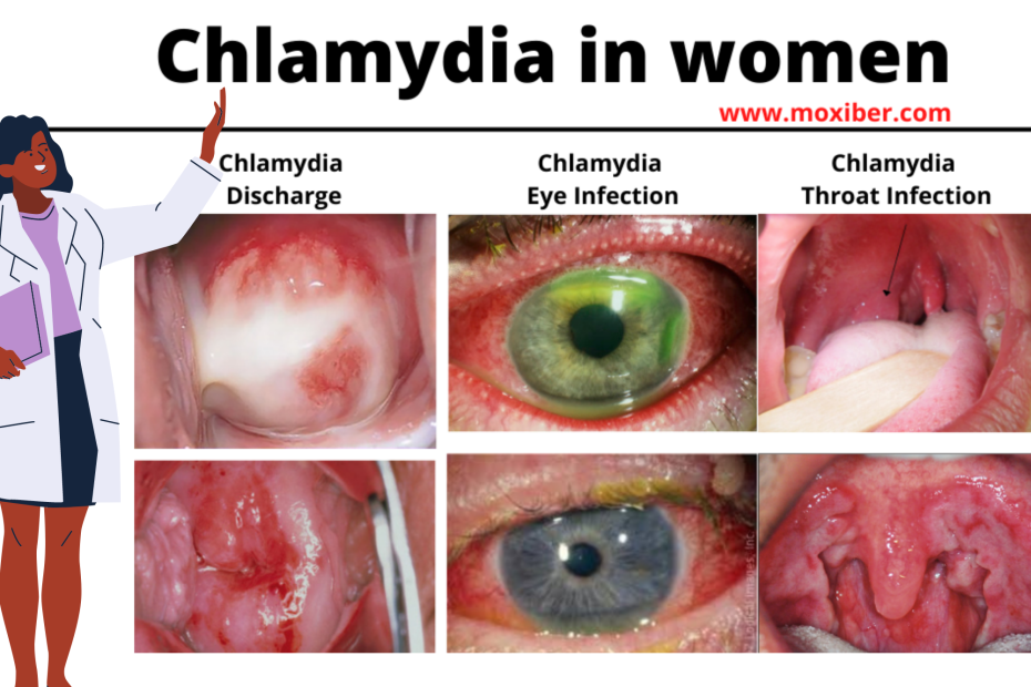 Chlamydia In Women Symptoms