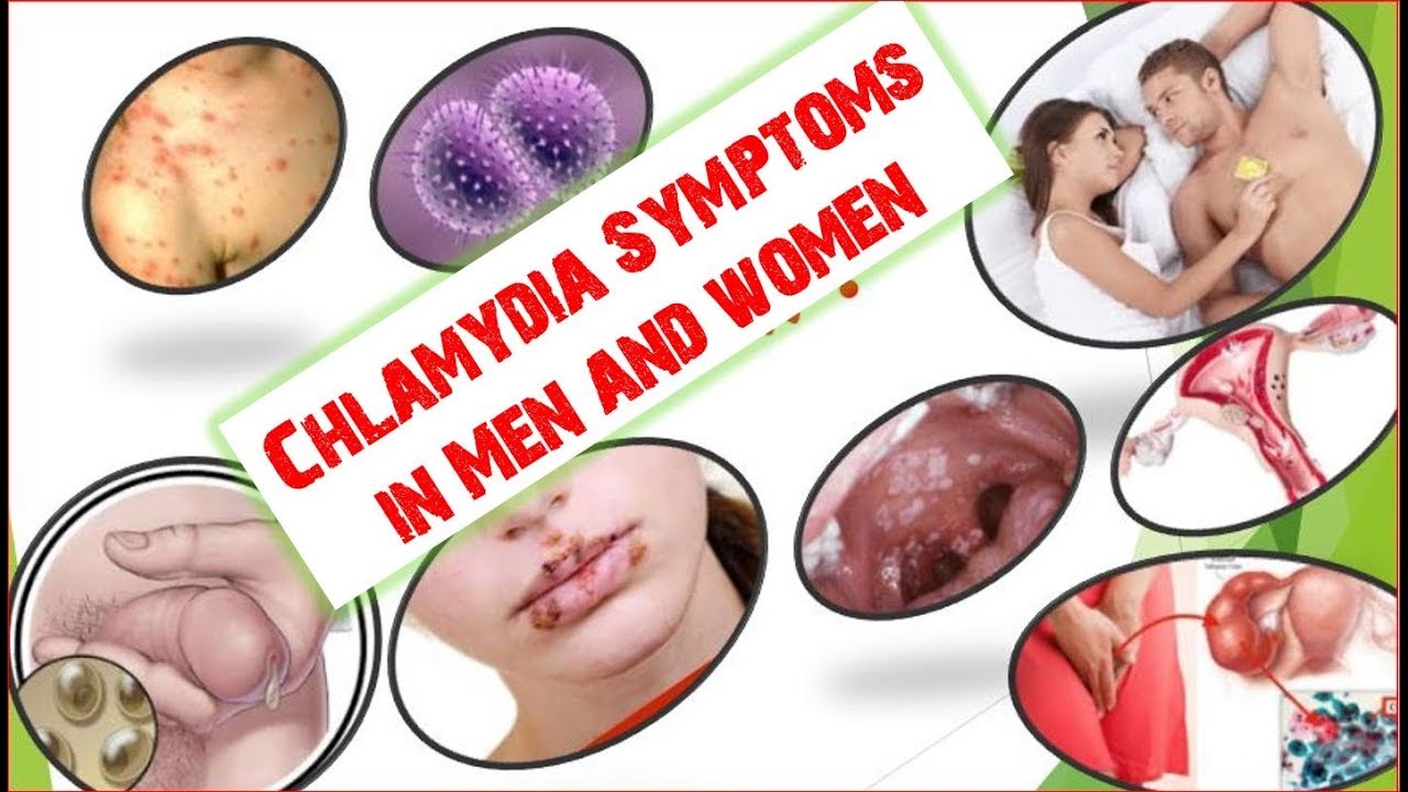 Chlamydia Symptoms in Men and women