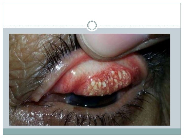 Chlamydia Trachomatis Under Eye