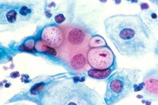 Chlamydia Treatment: Antibiotic capsules for chlamydia ...