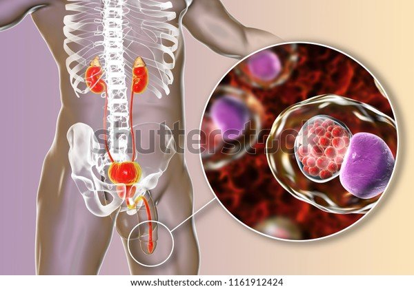 Chlamydiosis Infection Man 3d Illustration Showing Stock ...