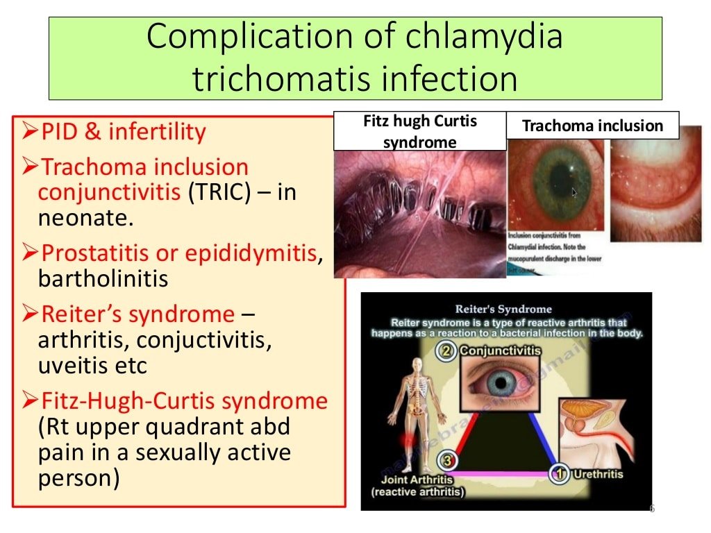 Clinical microbiology : Chlamydia trachomatis an overview ...