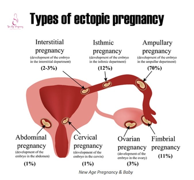 Ectopic Pregnancy: Causes, symptoms &  treatments
