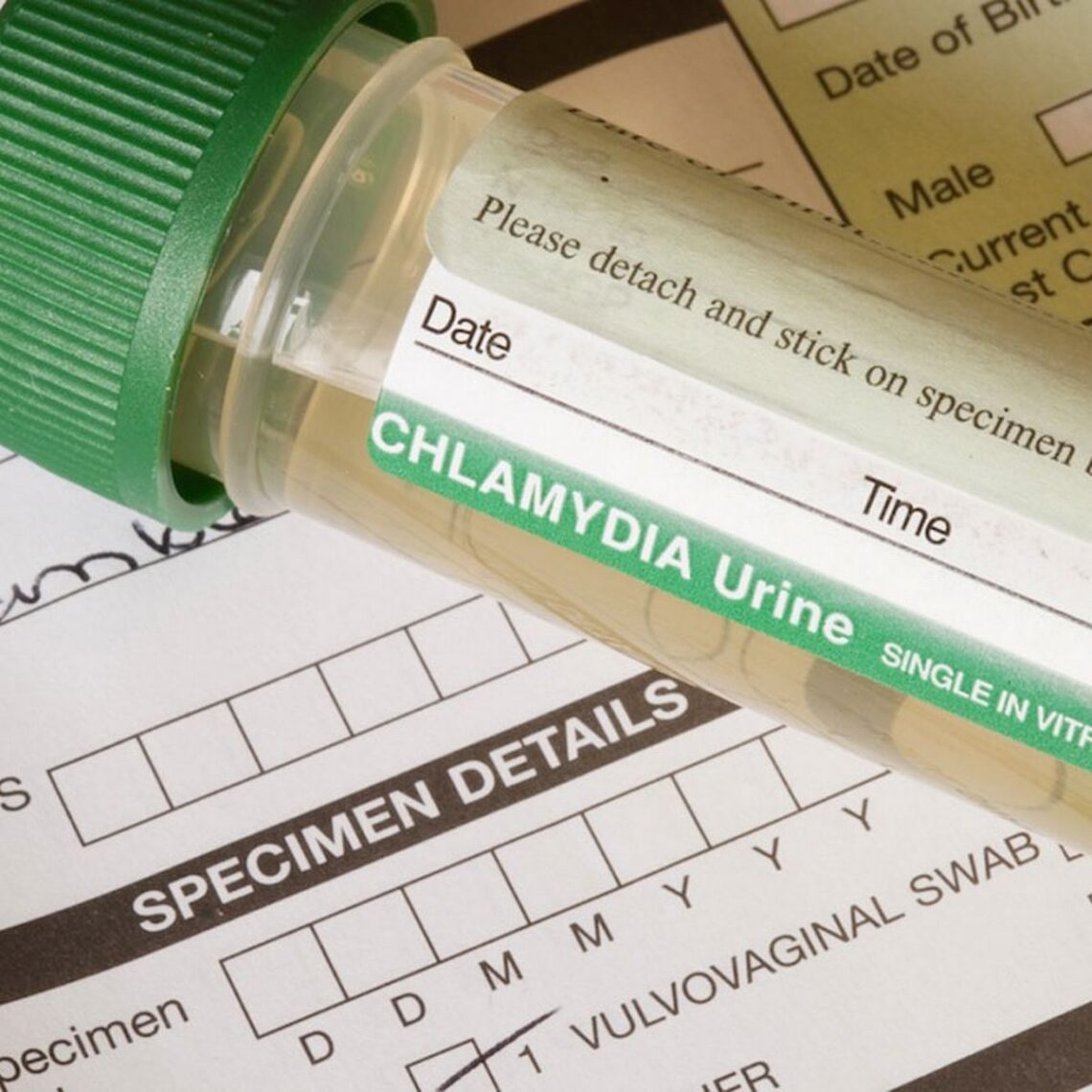 FREE Postal Chlamydia Test (for under 25