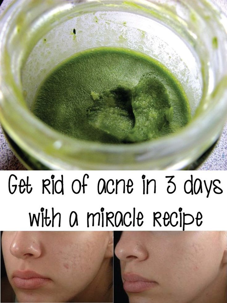 Get rid of acne in 3 days with a miracle recipe # ...