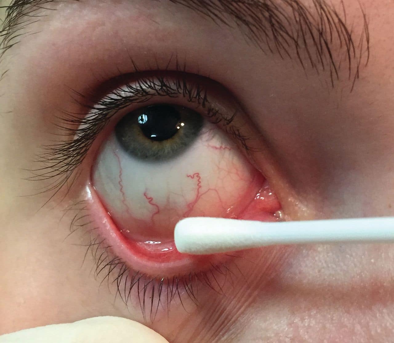 Gonococcal conjunctivitis: the importance of good