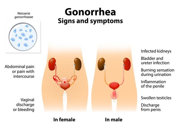 greeninteriordesigncenter: Free Gonorrhea Treatment