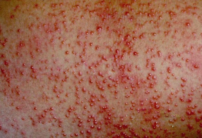 inner thigh rash pictures 4