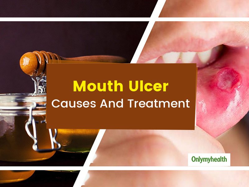 Mouth Ulcers: Try These Home Remedies To Get Rid Of Mouth ...