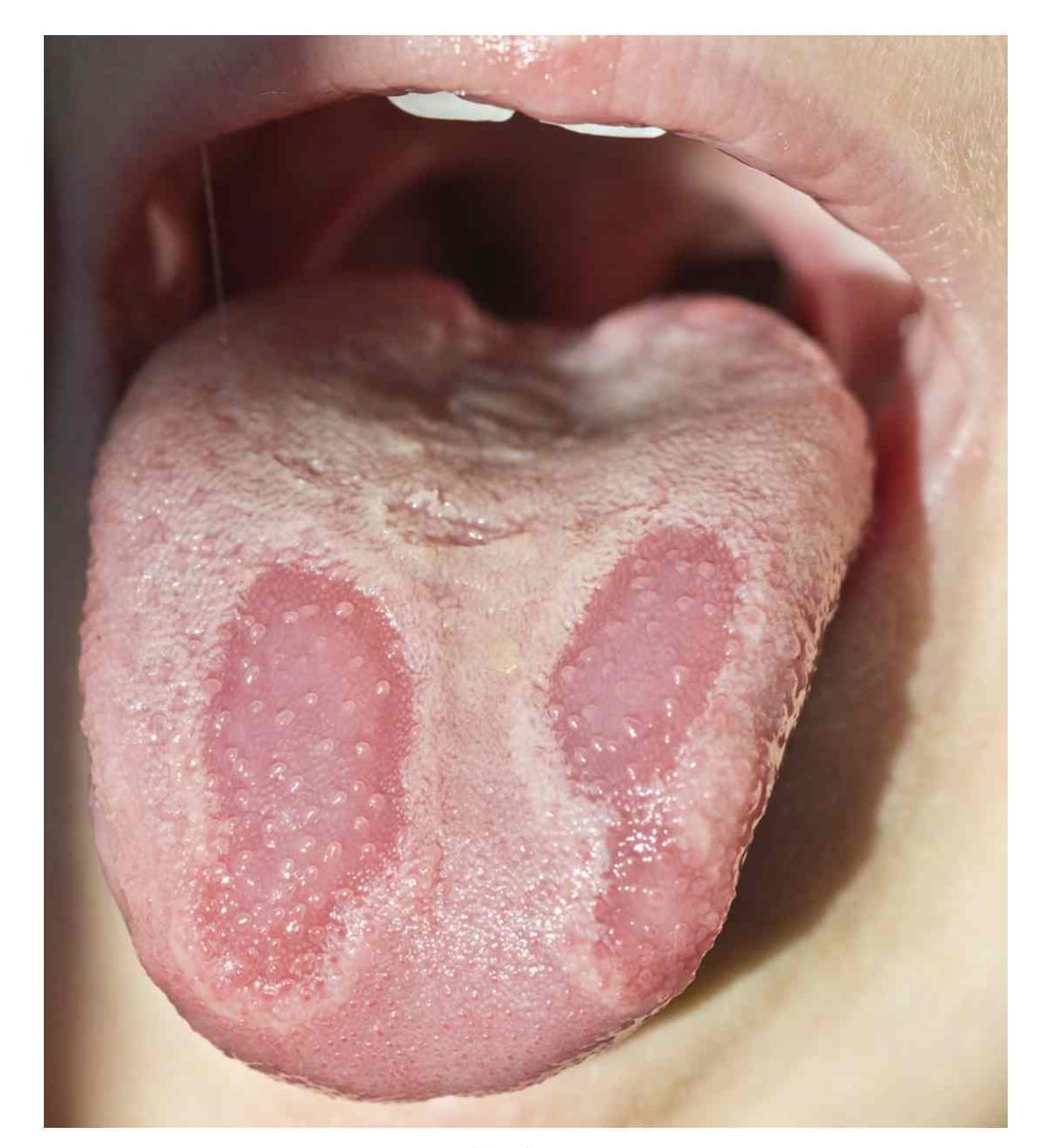 Mystery geographic tongue condition explained by physics