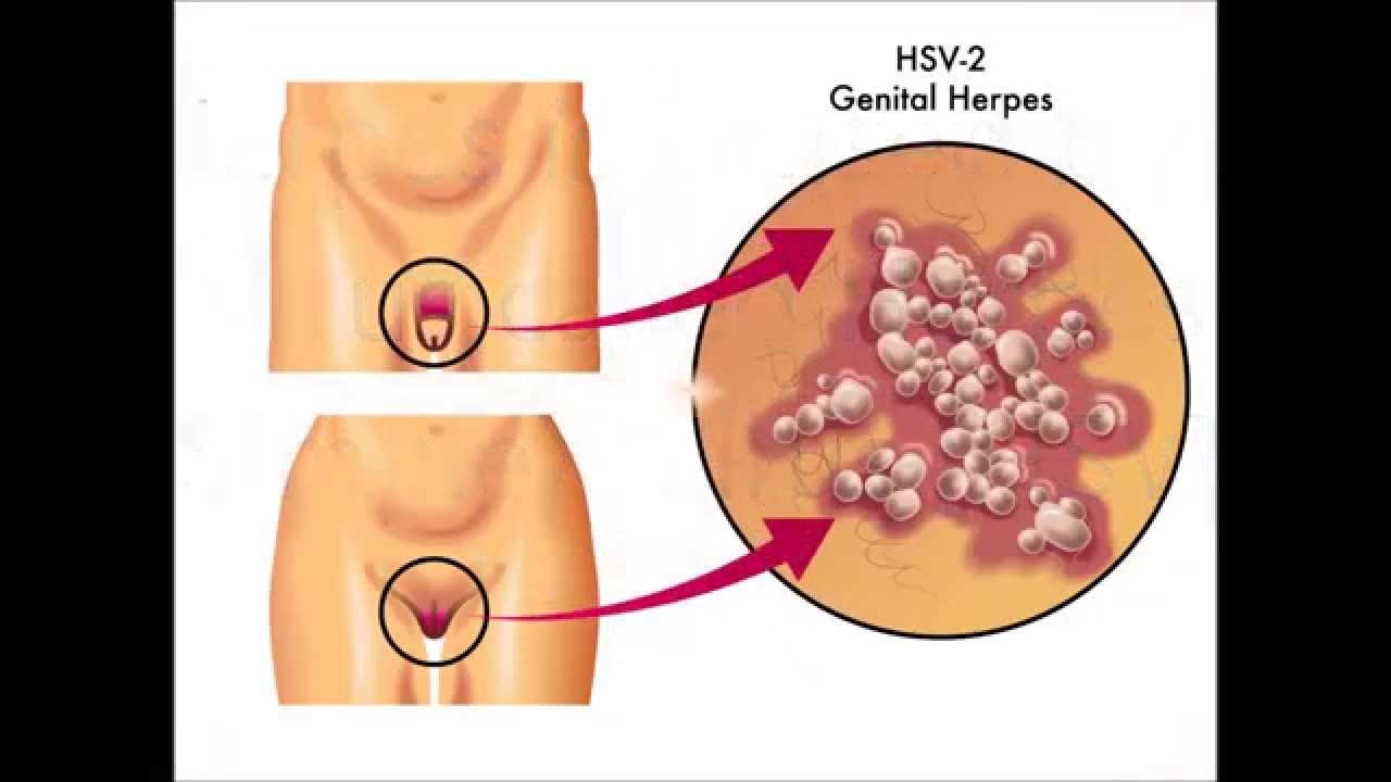 Natural Herpes Treatment Remove Herpes Naturally !