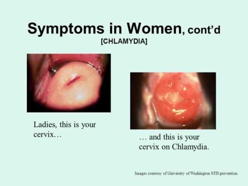 Page 4 for History, Symptoms and Treatment of Chlamydia