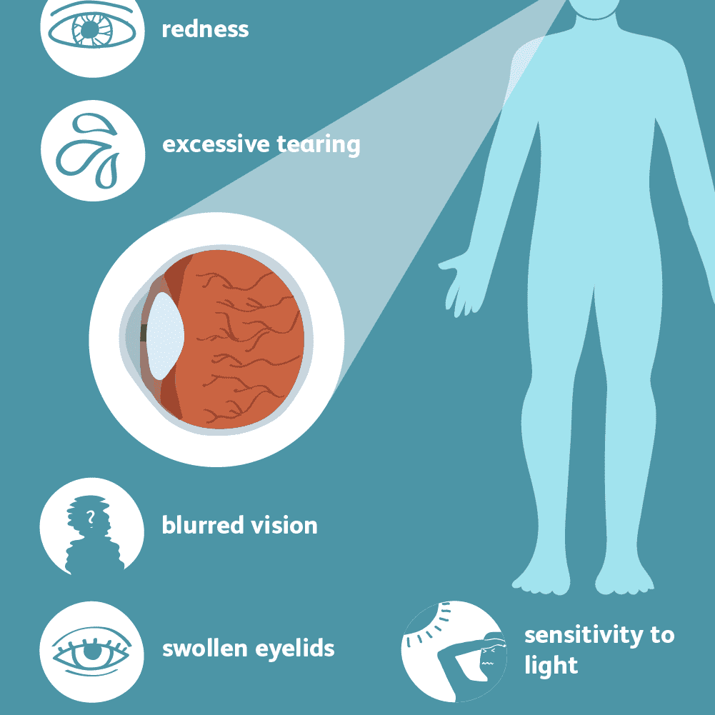 Pink Eye (Conjunctivitis): Symptoms and Complications