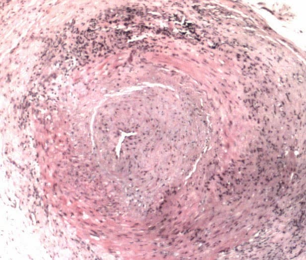 Presentation on the stomach: Giant Cell Arteritis