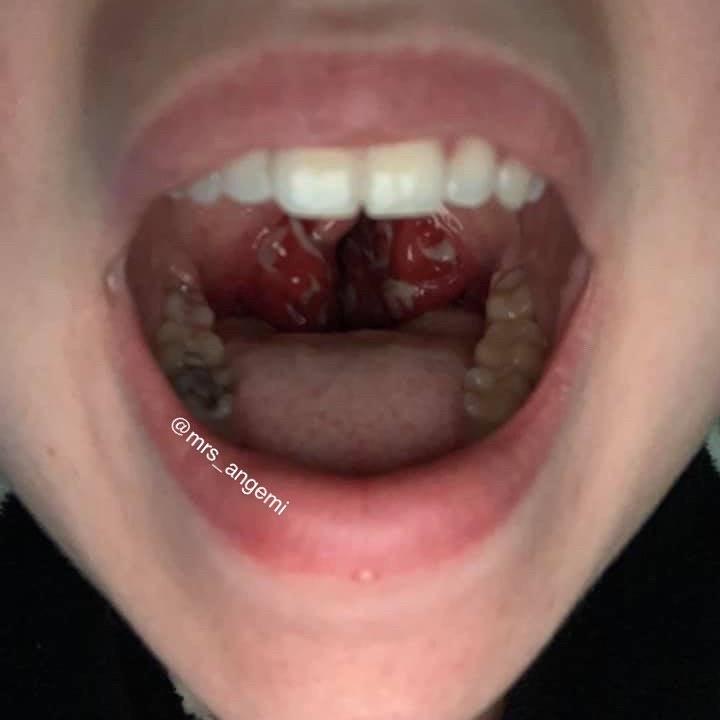 Severe tonsillitis caused by chlamydia infection in the ...