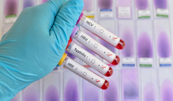 STDs and HIV Testing: Frequently Asked Questions