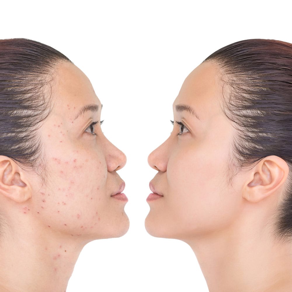 Tretinoin Before and After: How Long Does It Take to Work?
