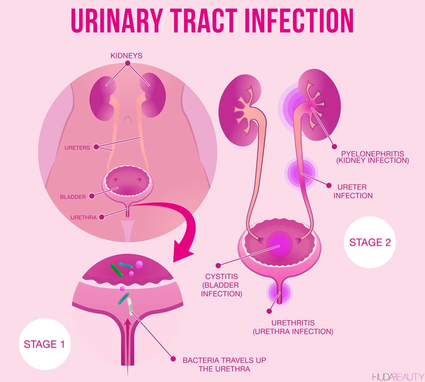 URINARY TRACT INFECTION (UTI) PACK