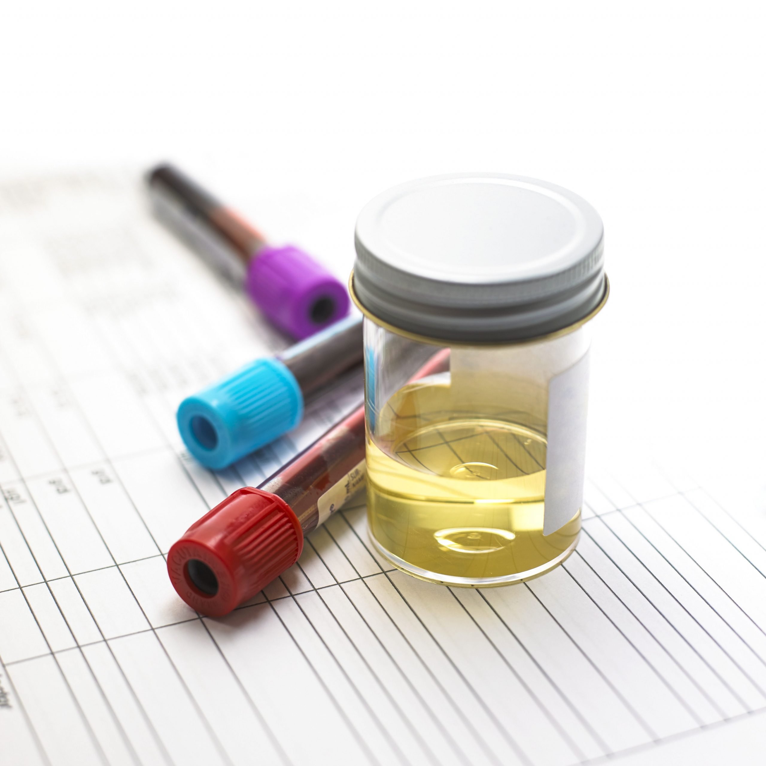 Urine Testing for Gonorrhea , Chlamydia, and Other STDs