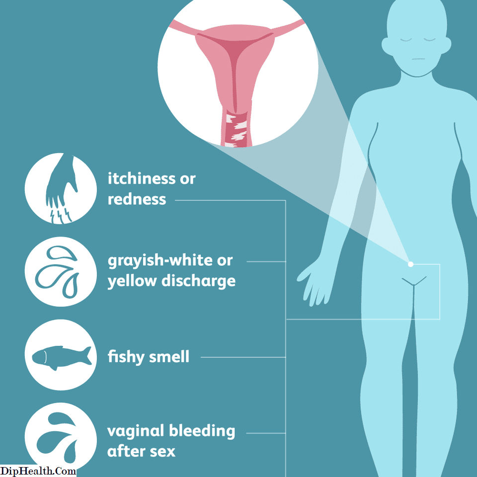 Vaginosis bacteriana: signos, sÃntomas y complicaciones