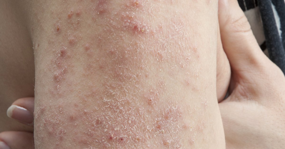Viruses That Cause Skin Rashes