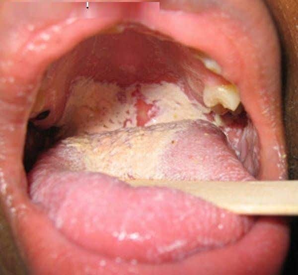 What Does Chlamydia Look Like On The Lips