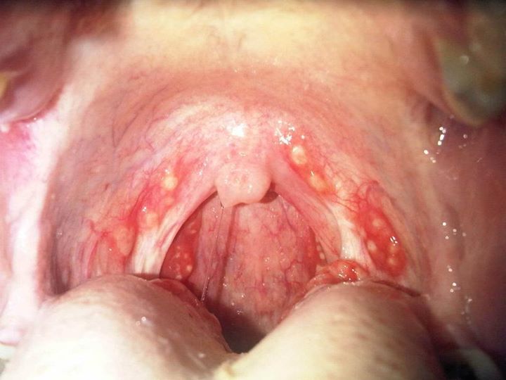 What Does Strep Throat Look Like?