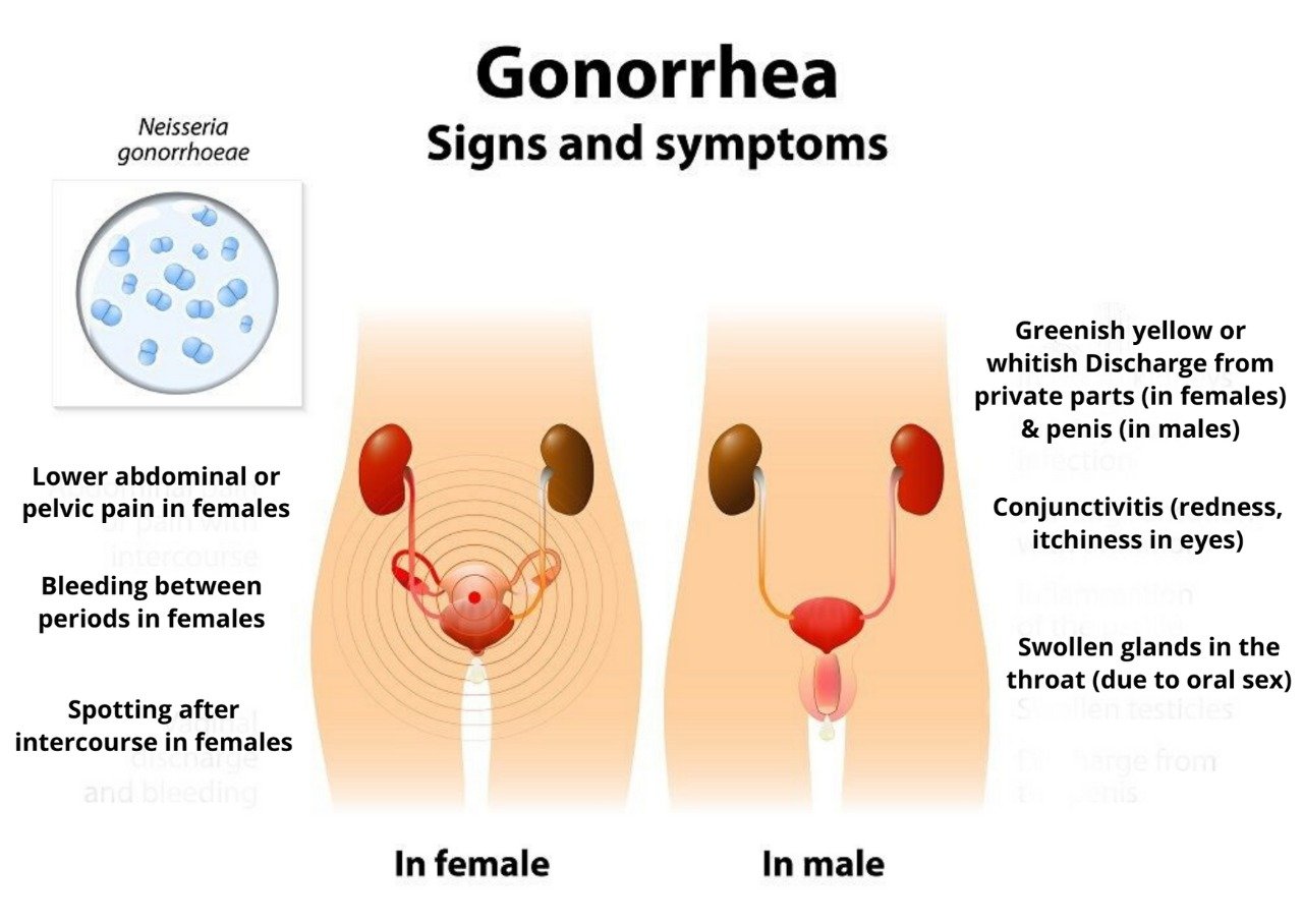 What Is Gonorrhea