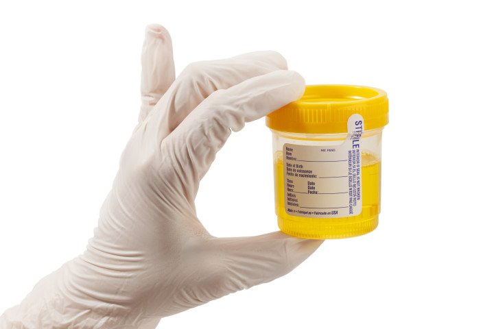 What Is the Accuracy of Urine Test for Chlamydia?